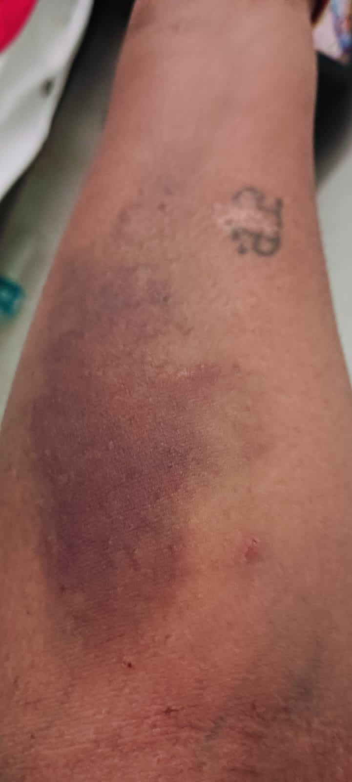 पीटना शुरू कर दिया